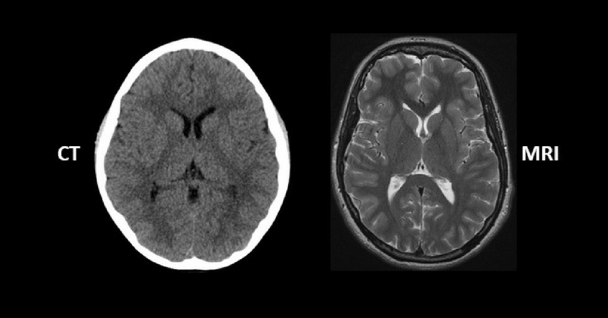 تفاوت سی تی اسکن مغز با ام آر آی مغز چیست